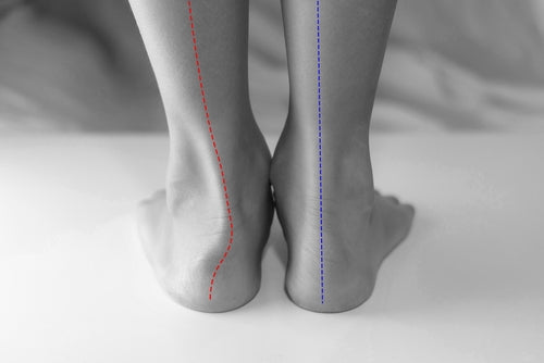 Foot deformities' impact on one's quality of life