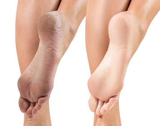 Why Females Are More Prone to Foot Issues Than Males