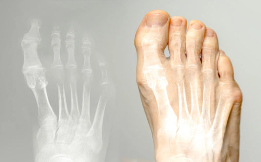 Hallux rigidus