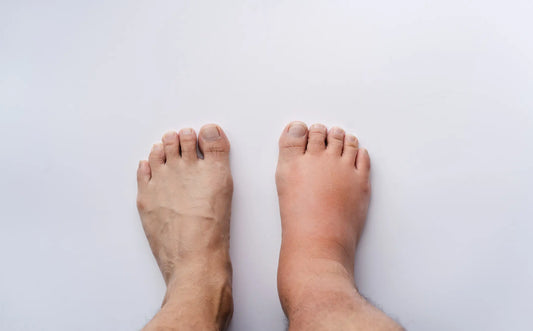 Pregnancy swelling