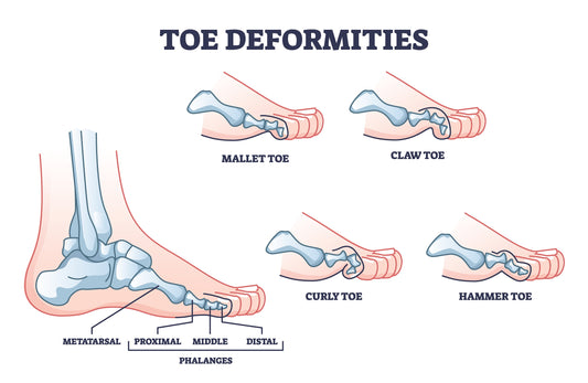 Hammer, Claw, and Mallet Toe