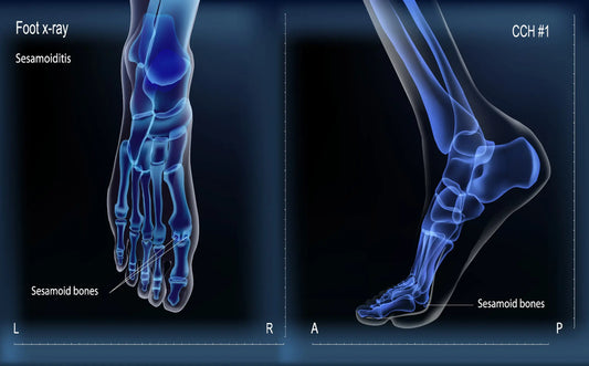 Sesamoiditis