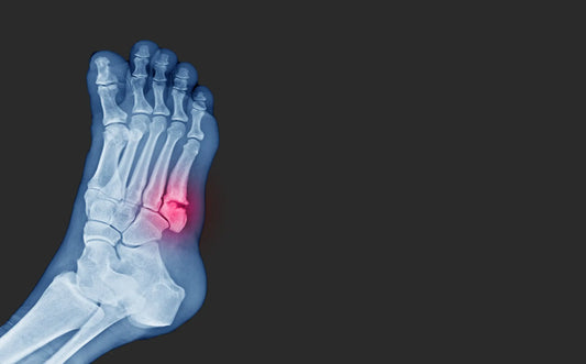 3 Different Types Of Foot Fractures