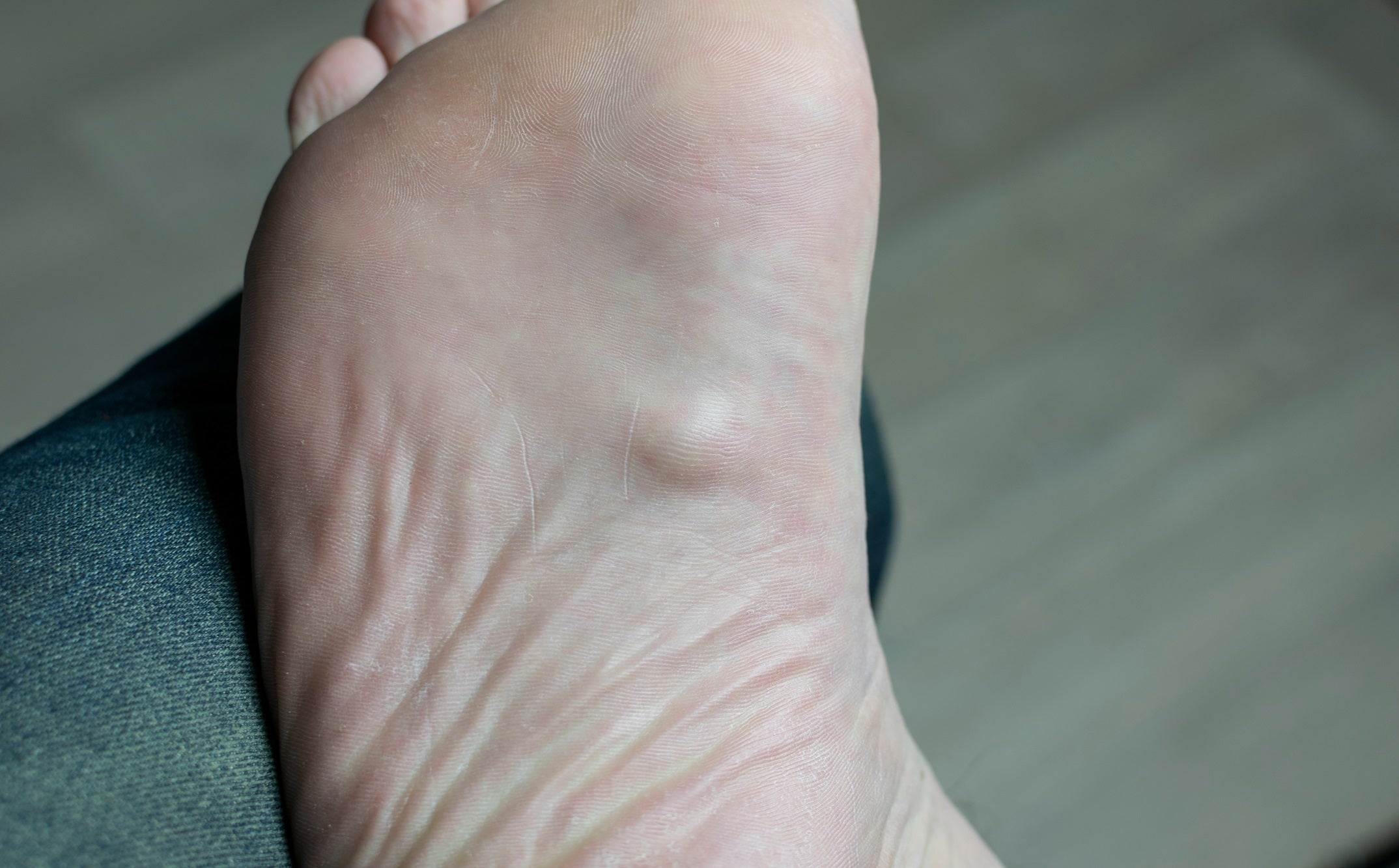 Plantar Fibromatosis – Drluigi