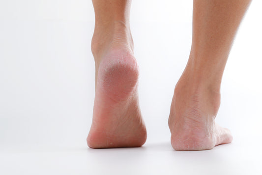 Do You Have Keratolysis With Pits?