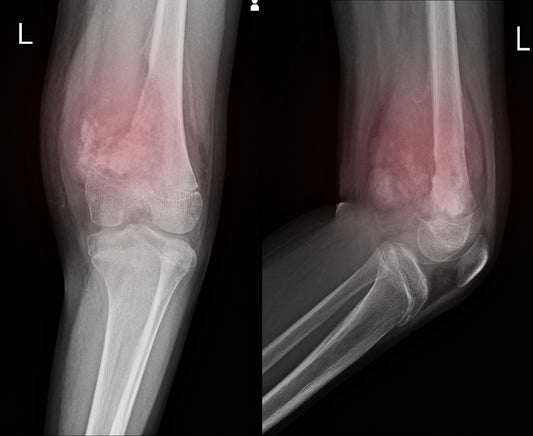 Kneecap Prepatellar Bursitis: Care and Recovery from this injury