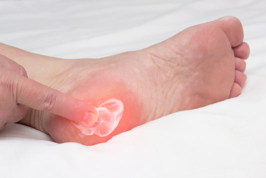 Heel spurs: What you need to know