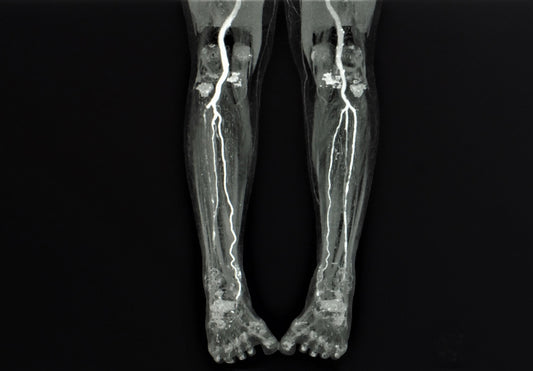 Peripheral arterial disease (PAD)