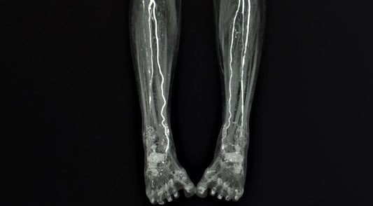 Takayasu's Arteritis