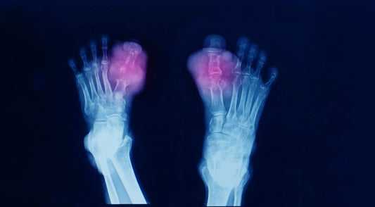 Tophaceous Gout