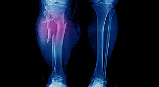 Compartment syndrome