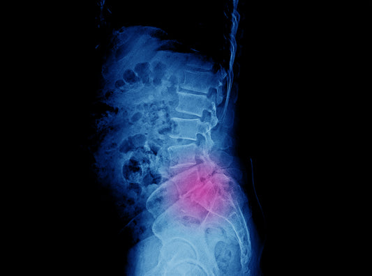 Plantar Fasciitis vs. Lumbar Radiculopathy