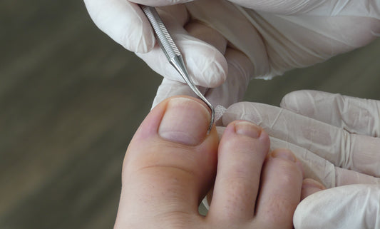 Treatments for Ingrown Toenails: Natural, Medical, and More