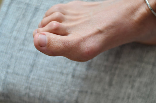 What is Hammertoe?