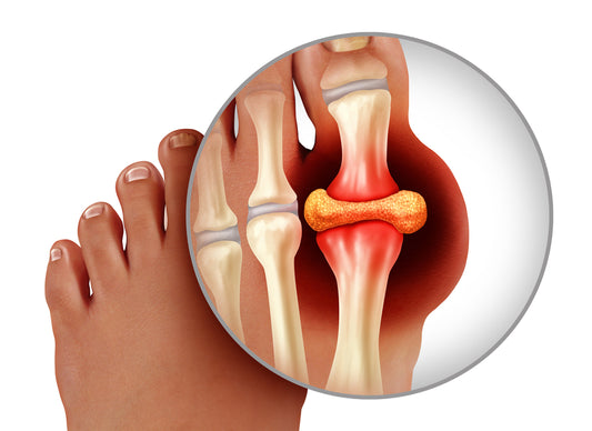 What is Gout?