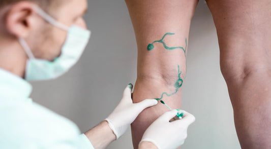 Blood Clots in Legs Understanding Deep Vein Thrombosis and its Treatment