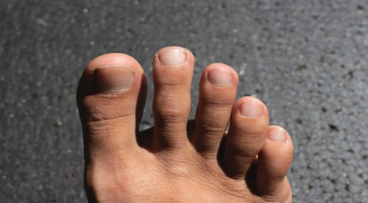 Plantar Fibroma