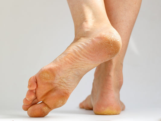 Calluses and corns