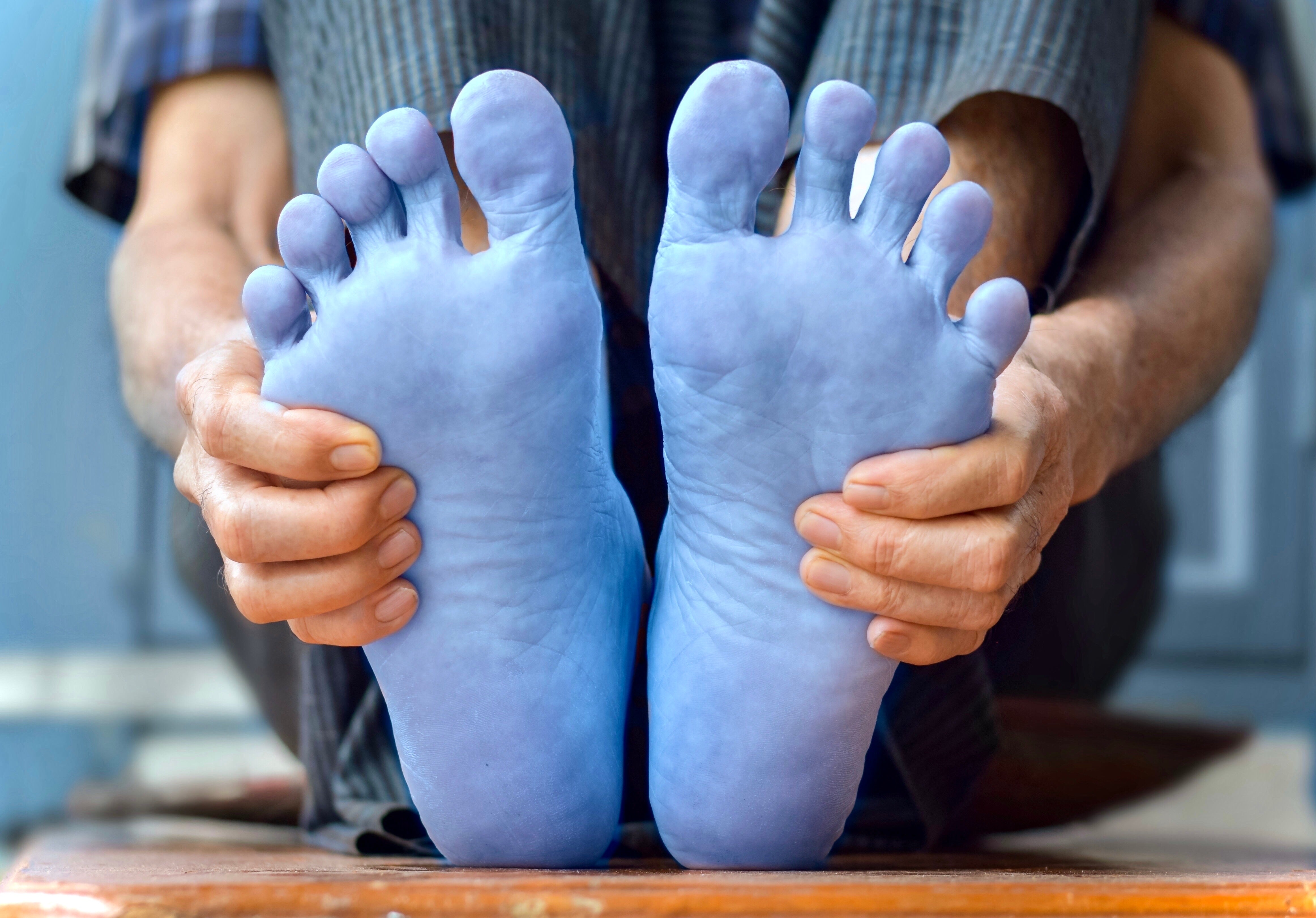 Ble Toe Blue toe syndrome – drluigi