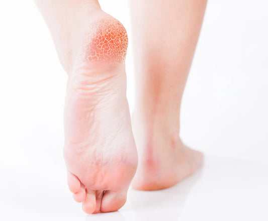 Best foot cures for dry skin