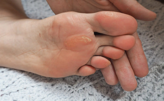 How to Avoid Foot Calluses