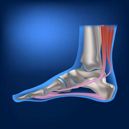 Tarsal Coalition